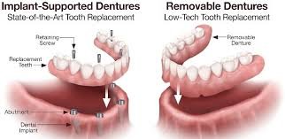 affordable dentures